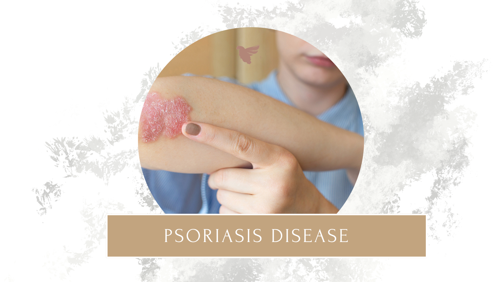 بیماری پسوریازیس چیست !؟