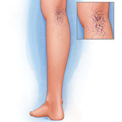 آيا واريس فقط يك مشكل ظاهری است؟