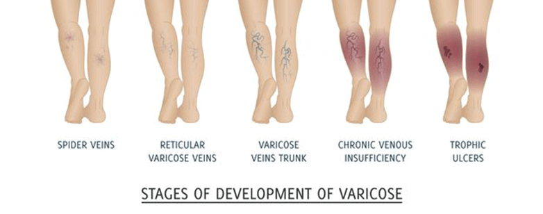 آيا واريس فقط يك مشكل ظاهری است؟